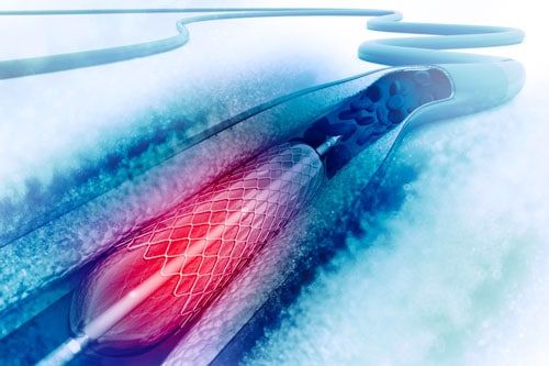 Coronary Angioplasty (PCI)