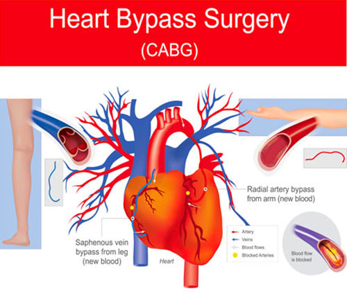 Coronary Bypass Surgery