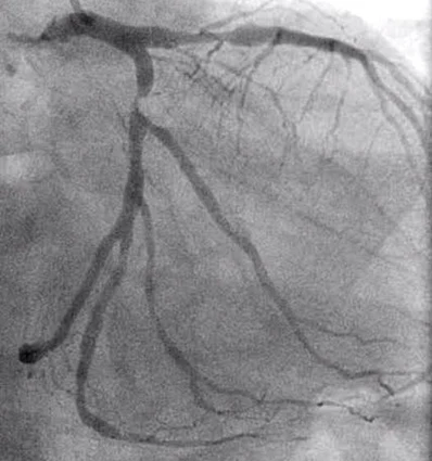 Coronary Angiogram