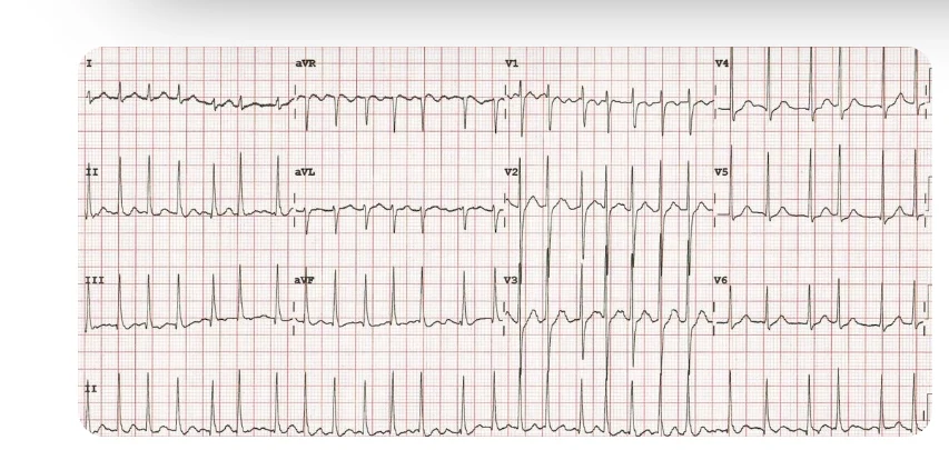 A 12-lead electrocardiogram (ECG) recording